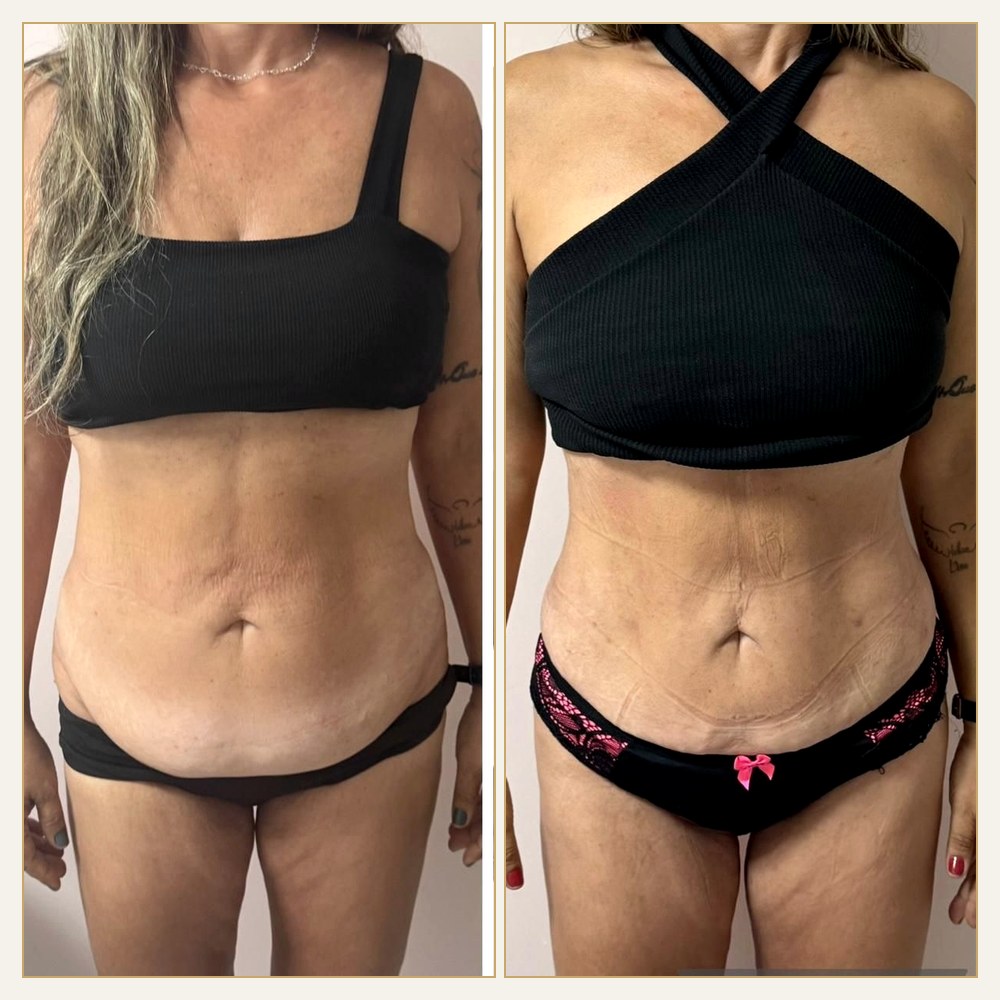 Antes & Depois