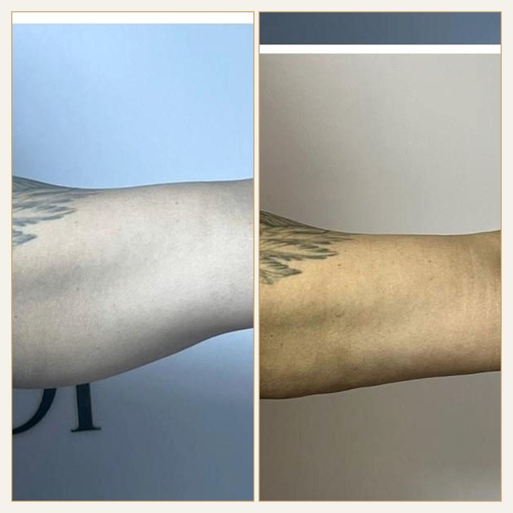 Antes & Depois